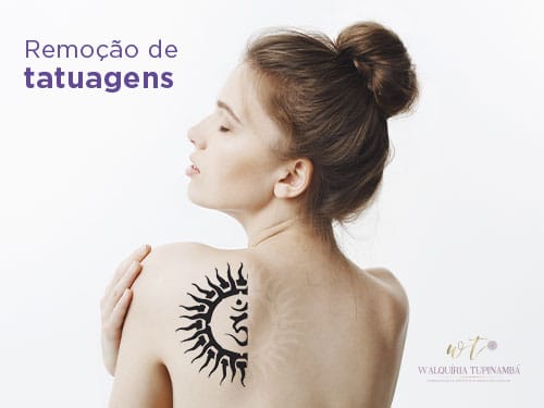 remoção de tatuagens Laser Harmony em Manaus